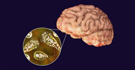  Brain-Eating Amoeba:  Could You Survive An Encounter With This Microscopic Monster?